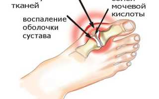 Можно ли употреблять вино при подагре?