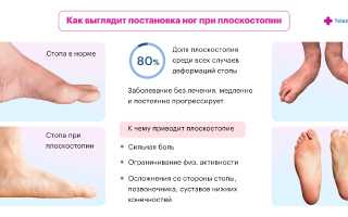 Плоскостопие: лечение и признаки заболевания