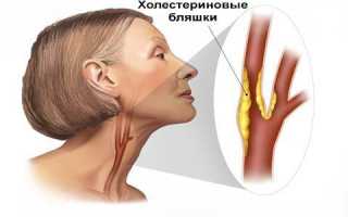 Лазерное удаление бляшек в сосудах