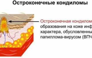 Генитальные бородавки