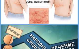 Герпес на теле лечение в домашних условиях