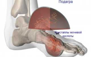 Гомеопатия — альтернативное лечение при подагре