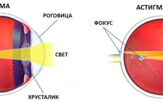 Нарушение зрения — астигматизм, что это? Причины, симптомы, лечение.