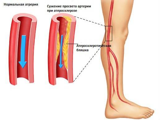 Окклюзия збба