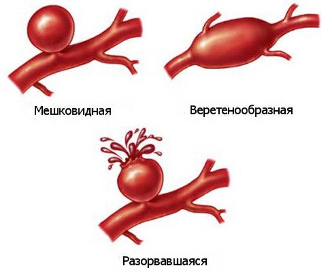 Окклюзия збба