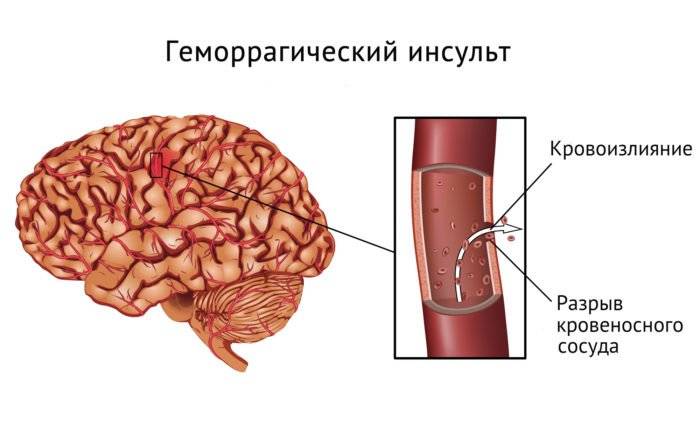 инсульт и инфаркт одновременно шансы выжить