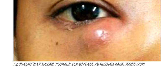 Абсцесс - причина жжения нижнего века