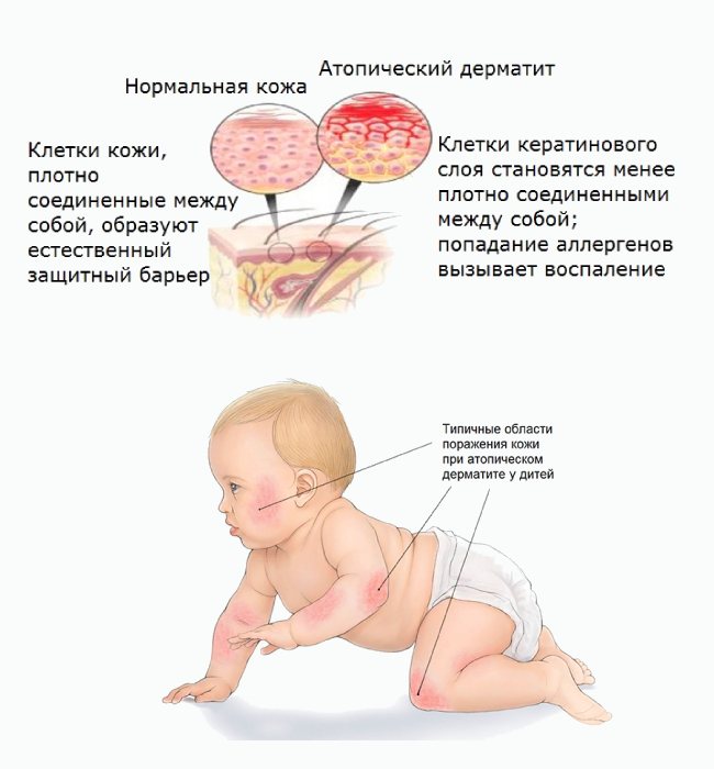 Атопический дерматит