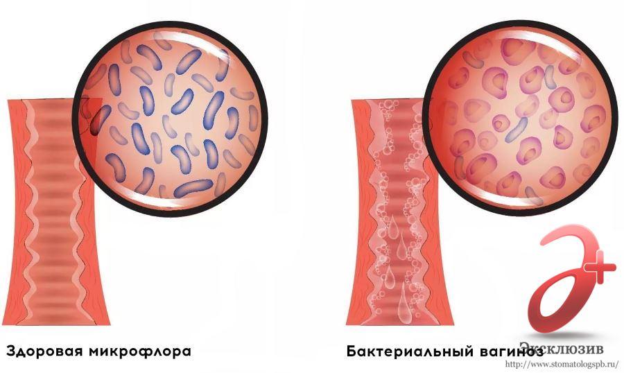 Бактериальный вагиноз (БВ)