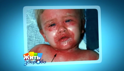 Болезнь Риттера