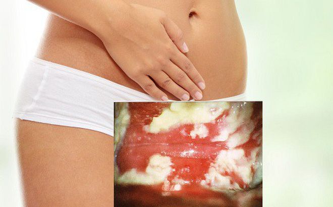 Candida albicans. Это наиболее частая причина зуда вульвы
