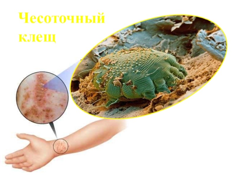 Чесоточный клещ