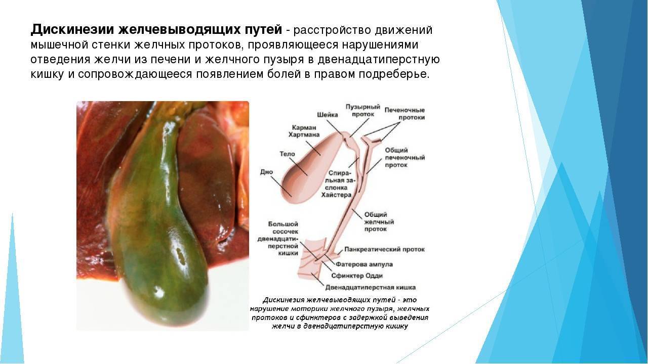 Дискинезия желчевыводящих путей