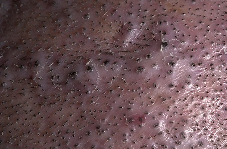 Фолликулит