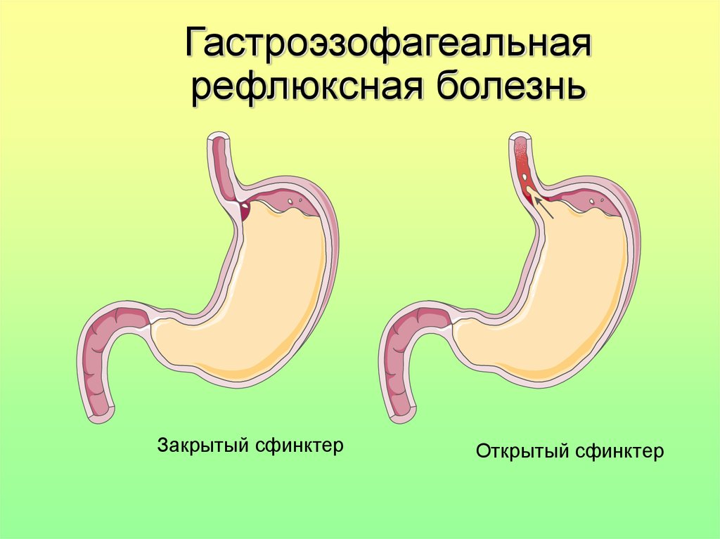 Гастроэзофагеальная рефлюксная болезнь