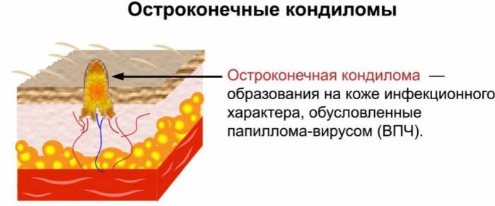 Генитальные бородавки