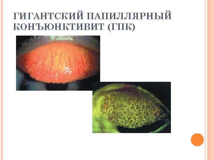 Гигантский папиллярный конъюнктивит симптомы