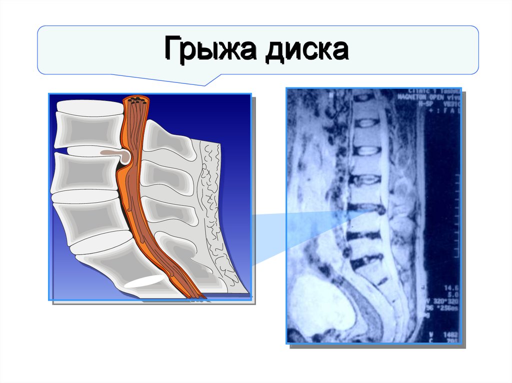 Грыжа диска