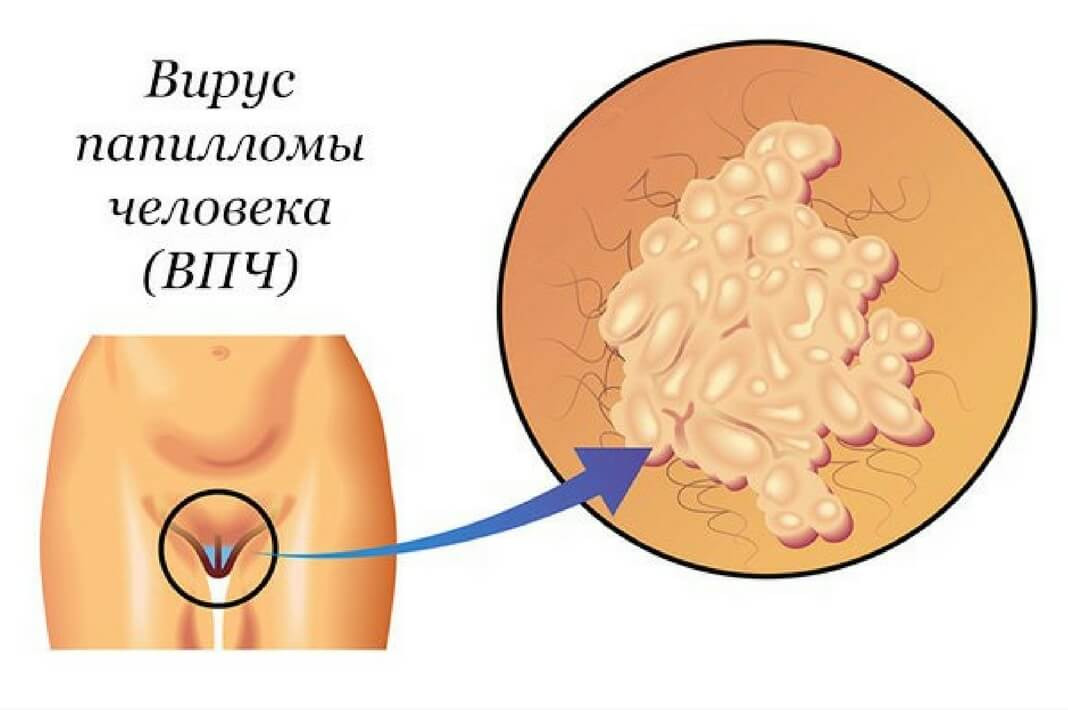 Инфекция вируса папилломы человека