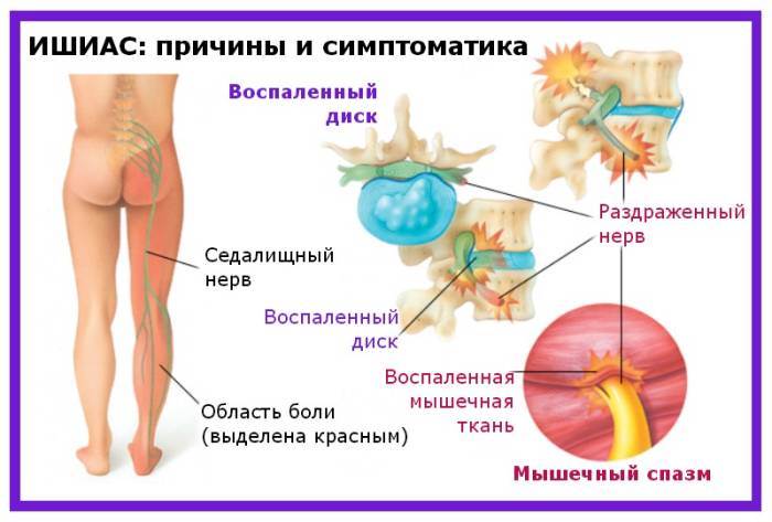 Ишиас