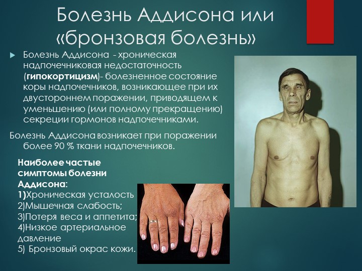 Изменения кожи при болезни Аддисона