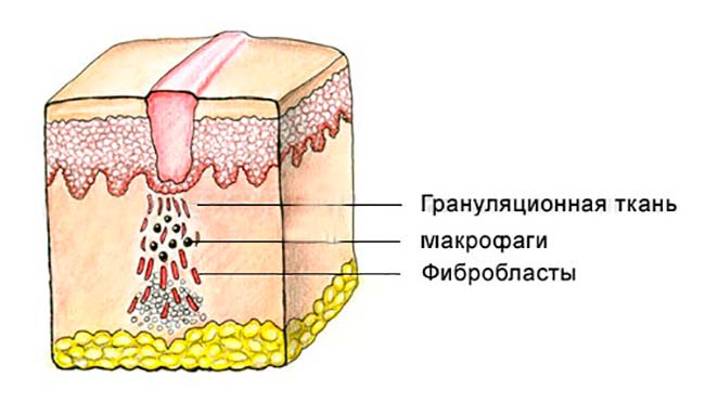 Как лечить грануляцию кожи