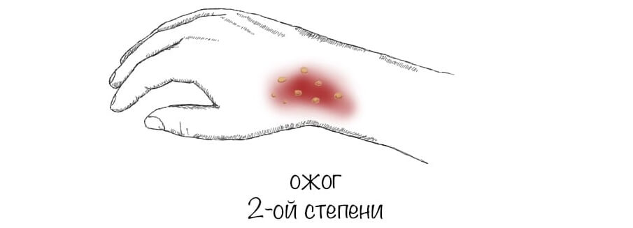 Как лечить ожоговый волдырь второй степени