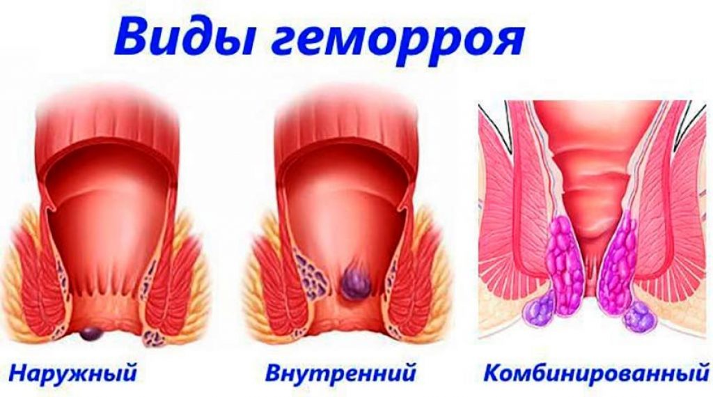Каковы причины геморроя