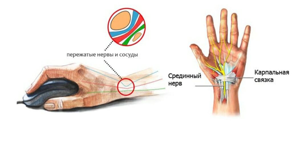 Компрессия нерва