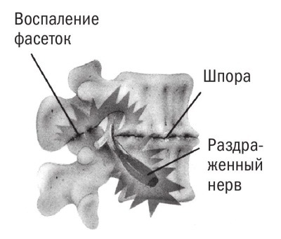 Костные шпоры