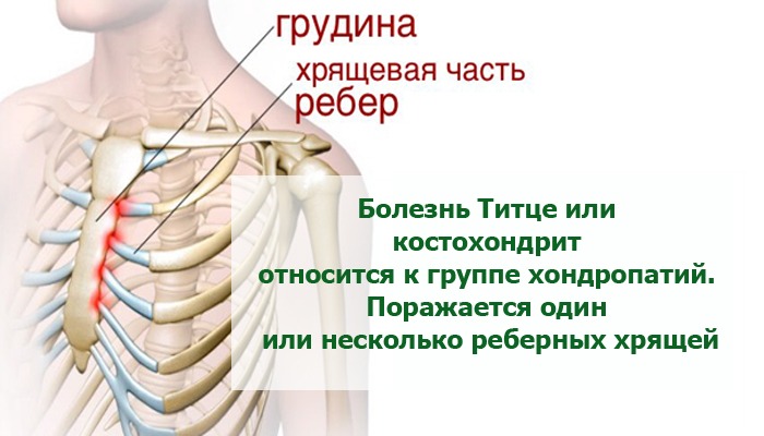 Костохондрит