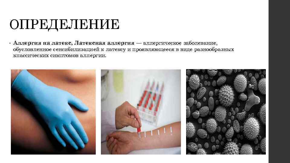 Кожные реакции от латекса