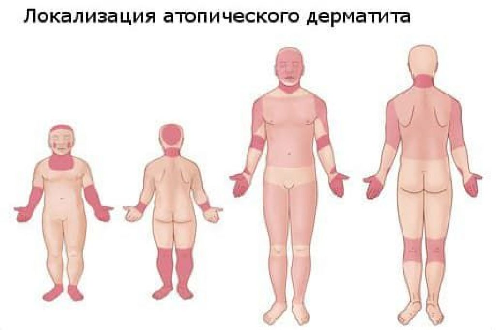 Лечение атопического дерматита у взрослых