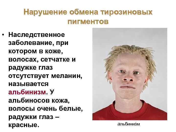 Меланин: заболевания
