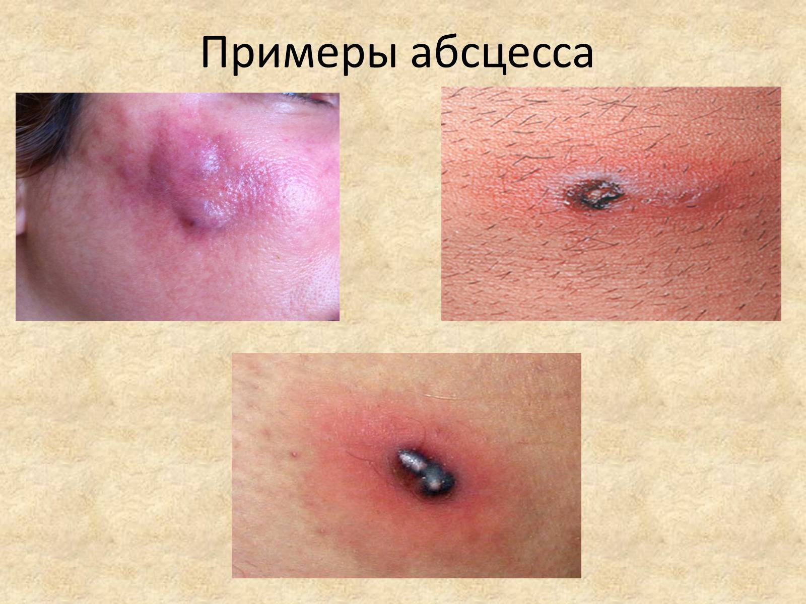 Множественные абсцессы кожи