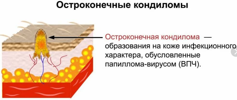 Остроконечные кондиломы