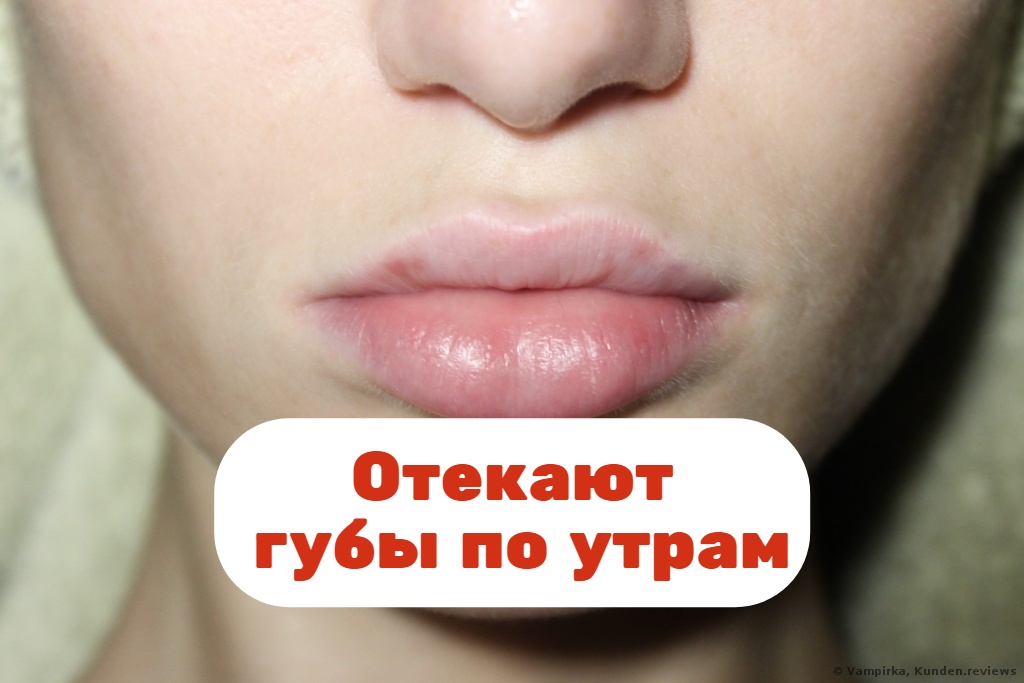 Отекают губы по утрам