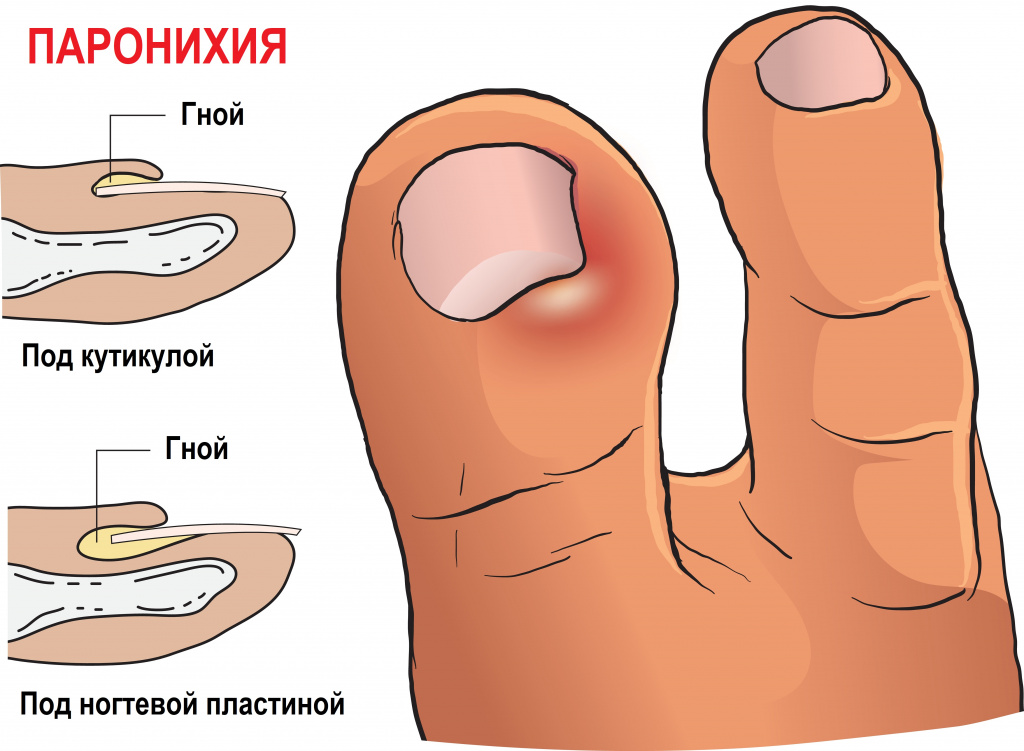 Паронихия ногтей на руках