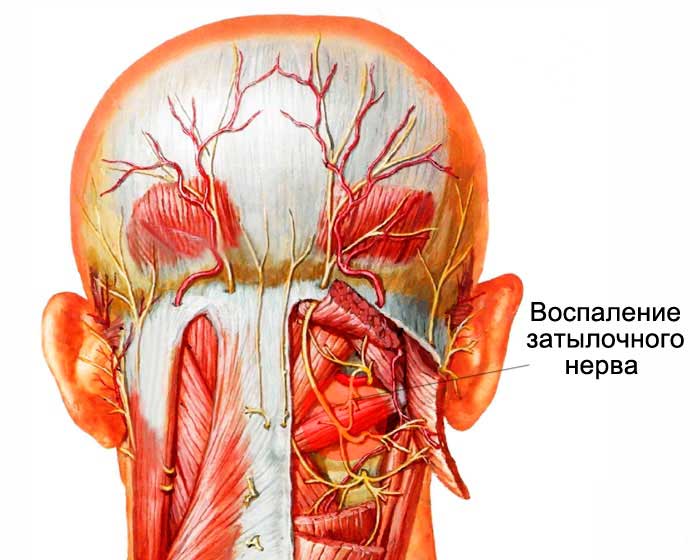 Повреждение затылочного нерва