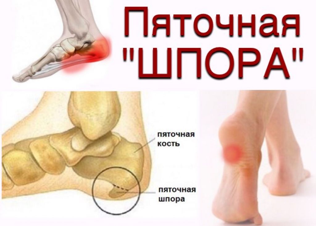 Пяточная шпора