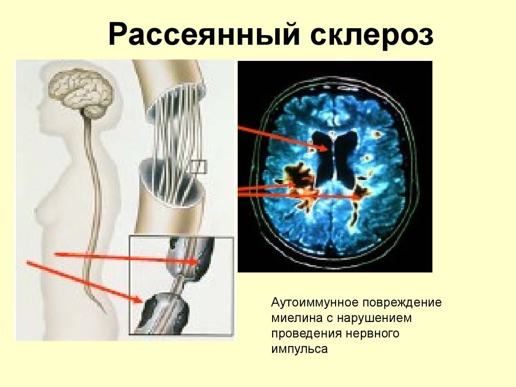 Рассеянный склероз