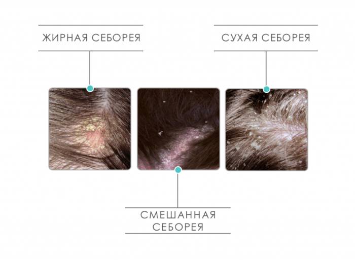 Себорейные заболевания кожи головы и лица