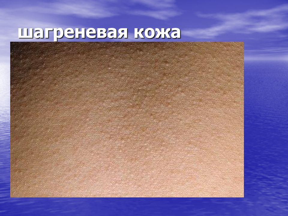 Шагреневая кожа как признак туберозного склероза