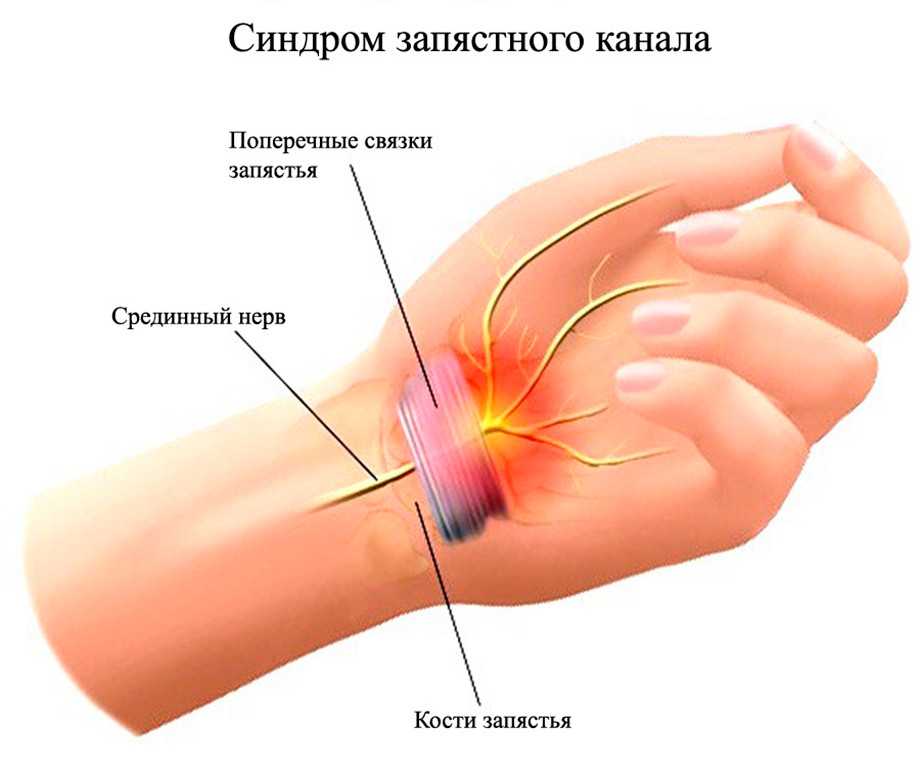 Синдром запястного канала