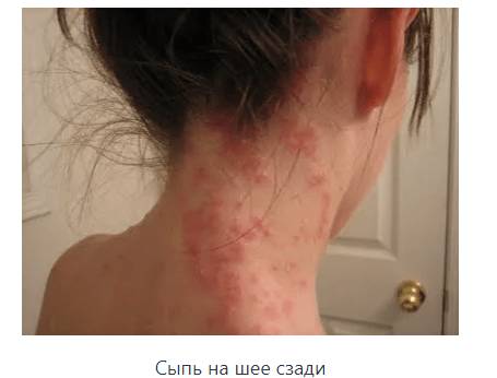 Сыпь на шее сзади с зудом или без