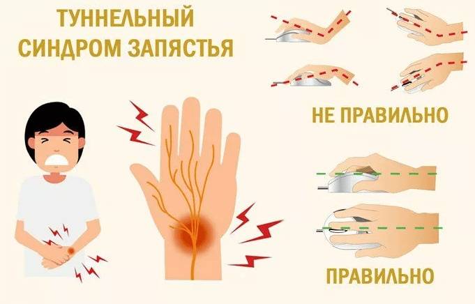 Туннельный синдром запястья