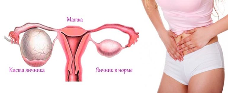 Яичник болит