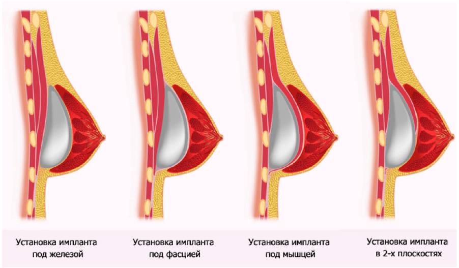 Жжение в груди после маммопластики