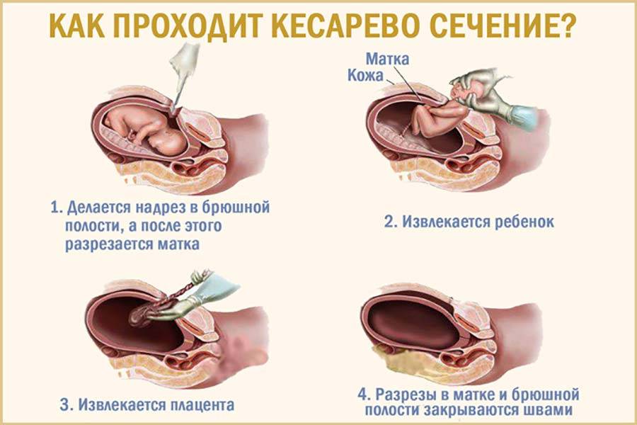 Жжение внутри после кесарева