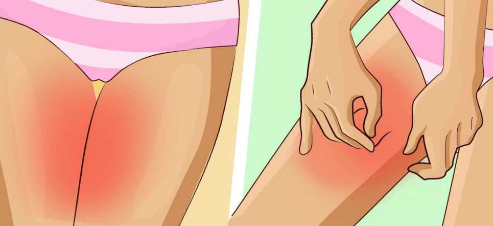 Зуд на внутренней стороне бедер причины